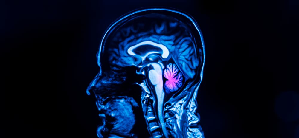 Sagittal MRI of the human brain at the corpus callosum level, with the cerebellum highlighted in red, showing vertigo-related changes.
